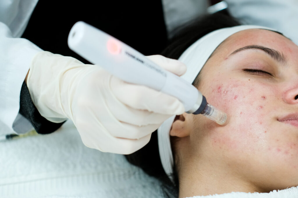 Microneedling Treatment