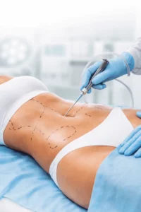 Client receiving Liquid Liposuction in Kansas City, MO RefineKC Aesthetics